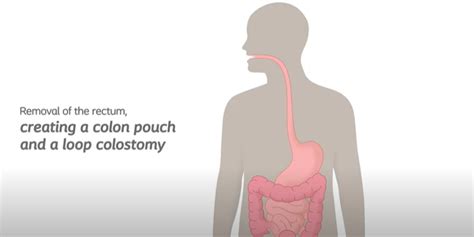 Understand Your Stoma Surgery Colostomy Coloplast Canada