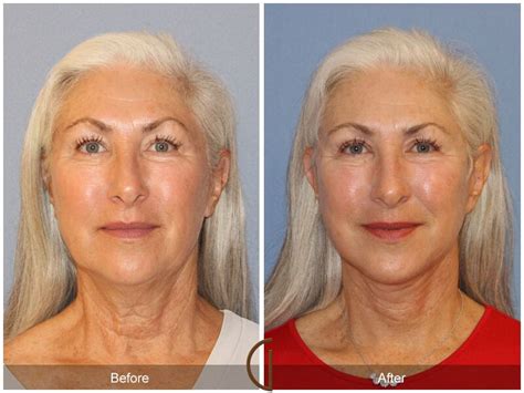 Neck Lift Before And After Photos Patient 76 Dr Kevin Sadati