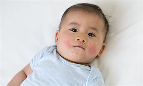 What Is Slapped Cheek Syndrome Parvovirus B19 Pampers
