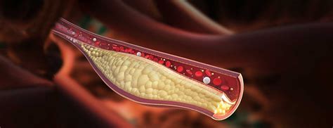 Cholesterol 5 Truths To Know Johns Hopkins Medicine