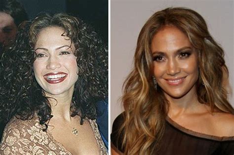 Jennifer Lopez Before And After Plastic Surgery 03 Celebrity Plastic