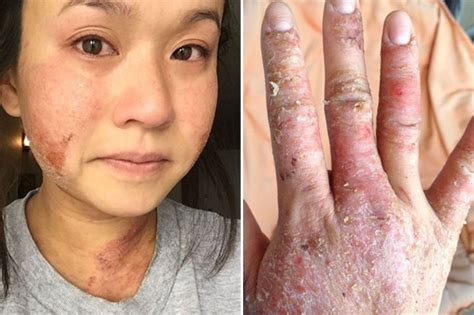 Boob Job Causes Such Severe Eczema That Woman Left Feeling Suicidal