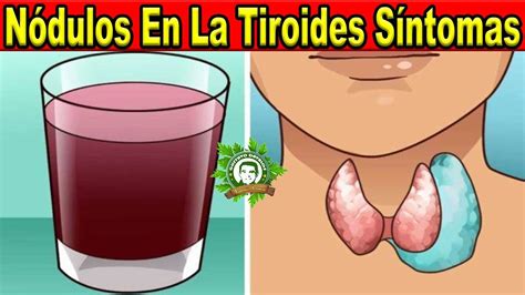 Nódulos En La Tiroides Síntomas y Tratamiento Natural Prueba Este Jugo