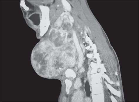 A Rare Case Of A Giant Congenital Multinodular Goiter With