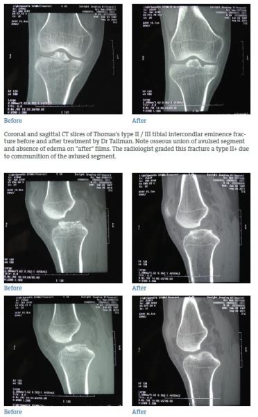 Tibial Intercondylar Eminence