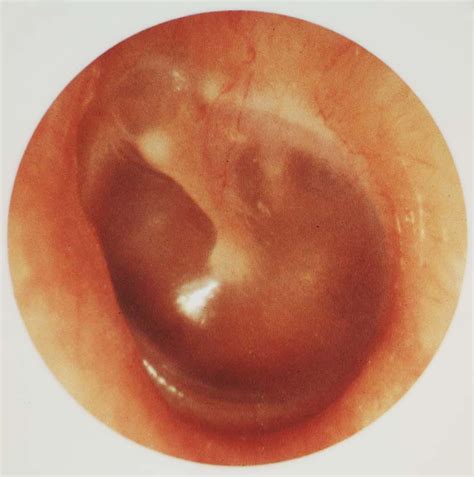 Complications Of Suppurative Otitis Media Epidemiology Routes Of Spread