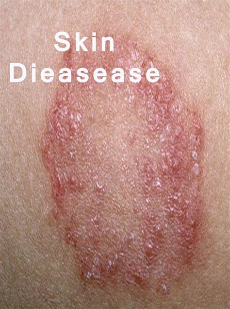 10 Most Common Skin Diseases
