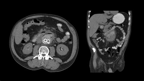 Prior To Transfer Ct Abdomen And Pelvis With Enteric Contrast Was