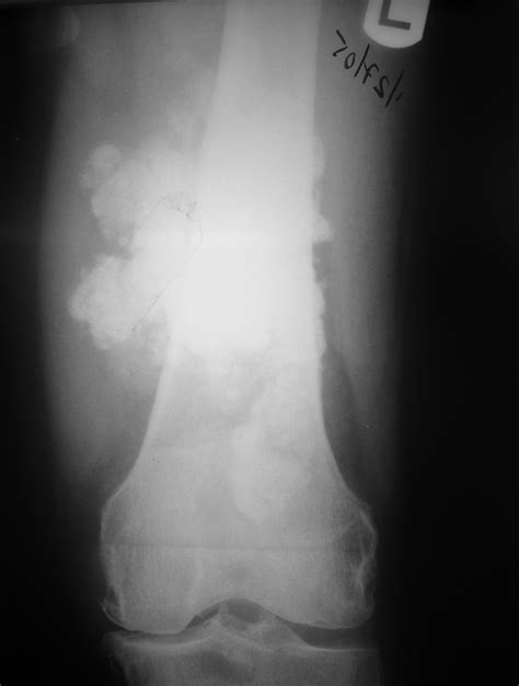 Extraskeletal Osteosarcoma Soft Tissue Osteosarcoma