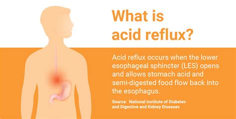 Acid Reflux Infographic