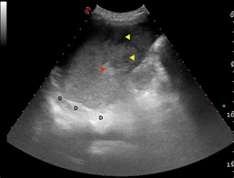 Splenic Rupture Visualised With Focused Assessment With Sonography For