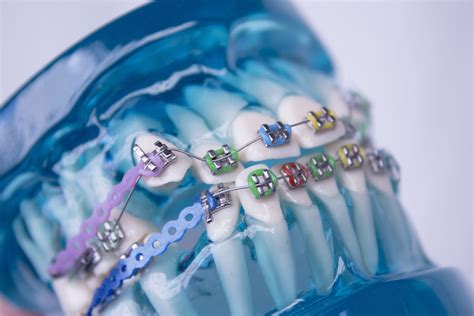 Whats The New Normal For Orthodontic Appointments Surrey