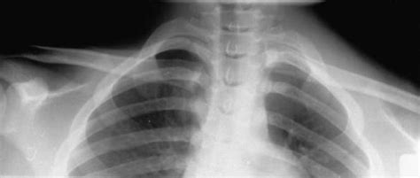 Medial Clavicle Fracture