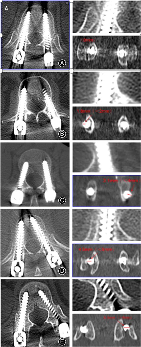 Typical Pedicle Screw Grading According To The Gertzbein And Robbins Download Scientific