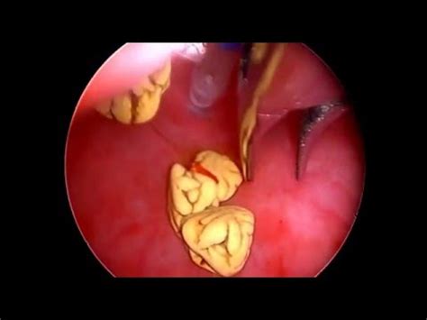 In some cases, struvite stones cannot be dissolved but have to be physically removed through surgery or other procedures. Surgical Video: Laparoscopic Removal of Bladder Stones ...