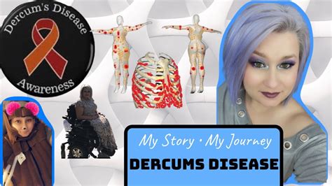 What Dercums Disease Does To The Body April 4th Dercums Disease