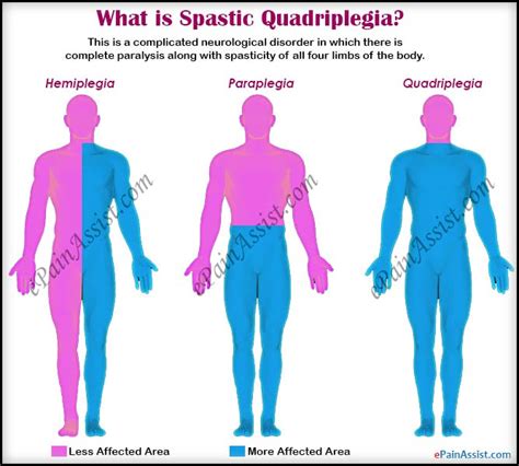 Spastic Quadriplegia Treatment Complications Symptoms Causes