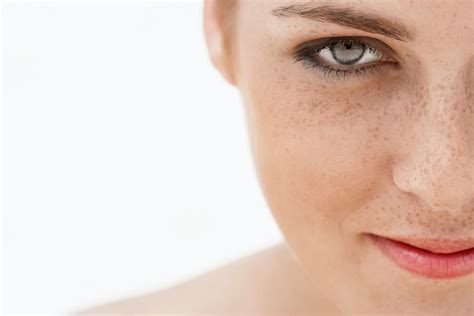 Everything You Need To Know About Getting Rid Of Freckles Vdg Anti Freckle Cream To Lighten