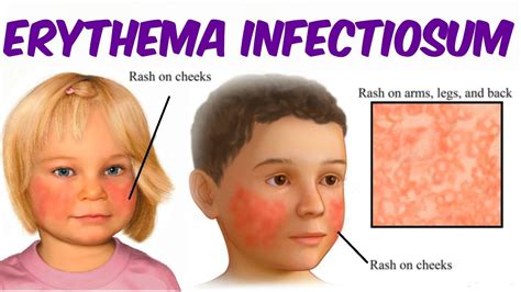Erythema Infectiosum Fifth Disease Youtube