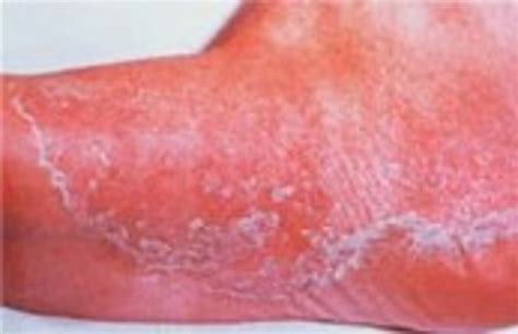 Ringworm Treatment Your Free Guide To Real Help Hubpages