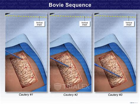 Bovie Sequence Trialexhibits Inc