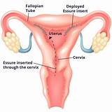 Coils In Fallopian Tubes Side Effects Images
