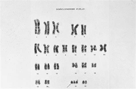 Down S Syndrome Karyotype 47 XX 21 Wellcome Collection