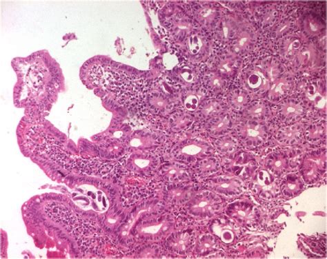 Duodenal Mucosa Showing Cross Section Of Strongyloides Stercoralis He