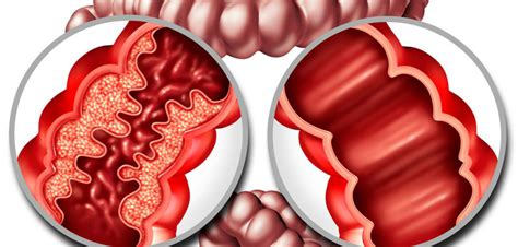 Crohns Disease Mi Endoscopia
