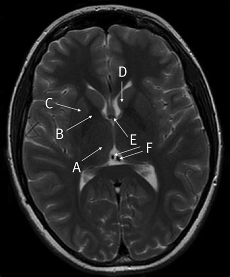 Anatomy Of The Brain T Weighted Magnetic Resonance Image Axial Section The Bmj