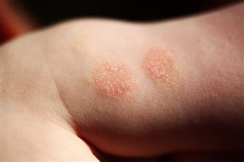 Nummular Eczema Symptoms Causes And Treatment