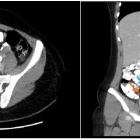 Abdominal Ct Scan Showing An Enhanced Appendix Not Filing With