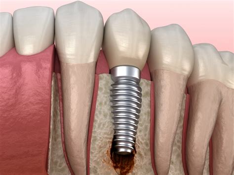 Failed Dental Implants Warning Signs And Prevention