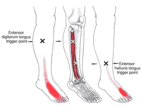 Langer Streckmuskel Unterschenkel Fuß The Trigger Point Referred Pain Guide