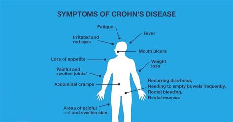 Crohn S Disease Specialist Los Angeles Ca Moshe Barnajian Md Fascrs Colorectal Surgeon