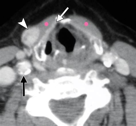 Imaging Of Ectopic Thyroid Tissue And Thyroglossal Duct Cysts