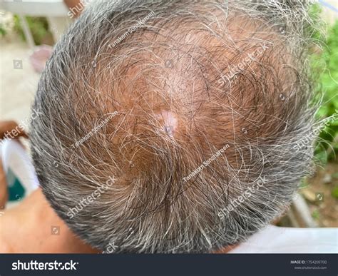 Tinea Capitis Fungal Infection On Scalp Stock Photo 1754209700