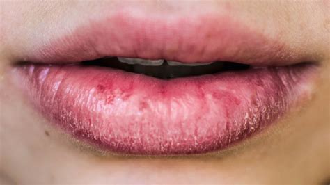 How To Treat Eczema On Your Lips Glamour Uk
