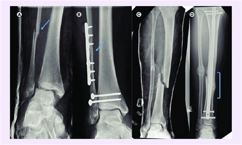 Primary And Secondary Bone Healing A Fibula Fracture See Arrow
