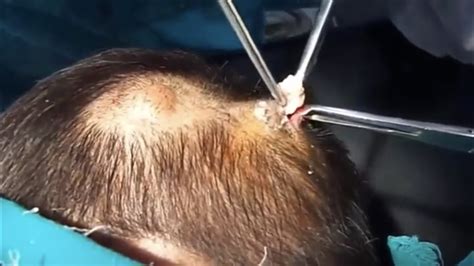 Removing Two Sebaceous Cysts From The Scalp New Pimple Popping Videos