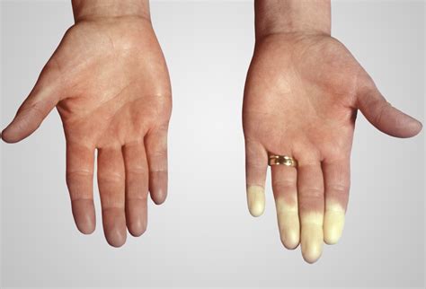 Raynaud Phenomenon Revisiting A Cold Weather Problem