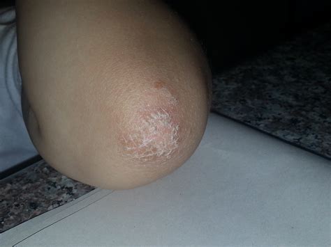 Small White Bumps On Arms And Dry Patches