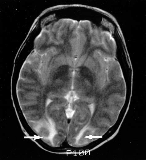 Etiology Of Cortical And White Matter Lesions In Cyclosporin A And Fk