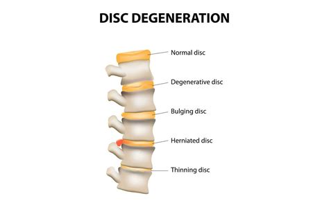 Degenerative Disc Disorder A Common Cause For Neck And Back Pain