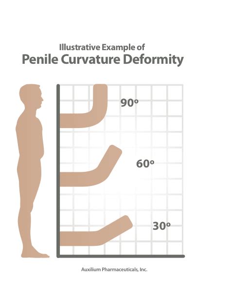 Possible Help For Men With Peyronies Crooked Penis Disease Commonhealth
