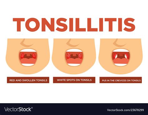 Tonsillitis Red And Swollen Tonsils White Spots Vector Image