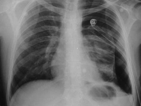 Chest X Ray Shows Persistent Pneumothorax After Chest Tube Insertion