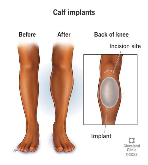 Calf Implants Surgery Recovery Side Effects And Scars