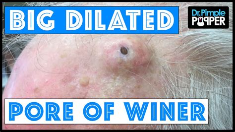 The Popping Of A Huge Dilated Pore Of Winer Video Daily Headlines