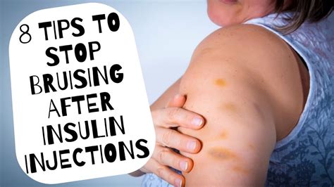 8 Tips To Stop Bruising After Insulin Injections Youtube